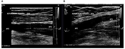 Evaluation of Lower Limb Arteriovenous Diameters in Indoor Soccer Athletes: Arterial Doppler <mark class="highlighted">Ultrasound Study</mark>